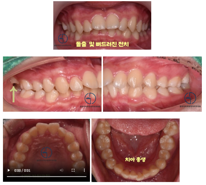 어금니가 어긋난 가위교합(sissors bite) 방치하면 턱관절에도 영향을?! 면목동 교정치과