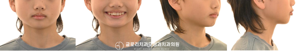 중랑구 교정치과 인비절라인 퍼스트, 우리 아이 삐뚤빼뚤한 치아도 어린이교정으로 개선될 수 있을까요?