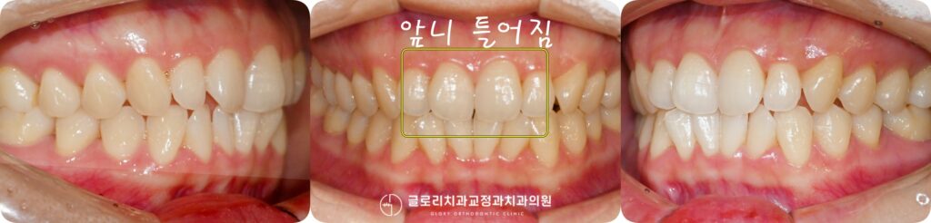 중화동 치과 삐뚤어진 앞니, 윗니만 치료하고싶어요, 미니튜브를 이용한 상악 부분교정