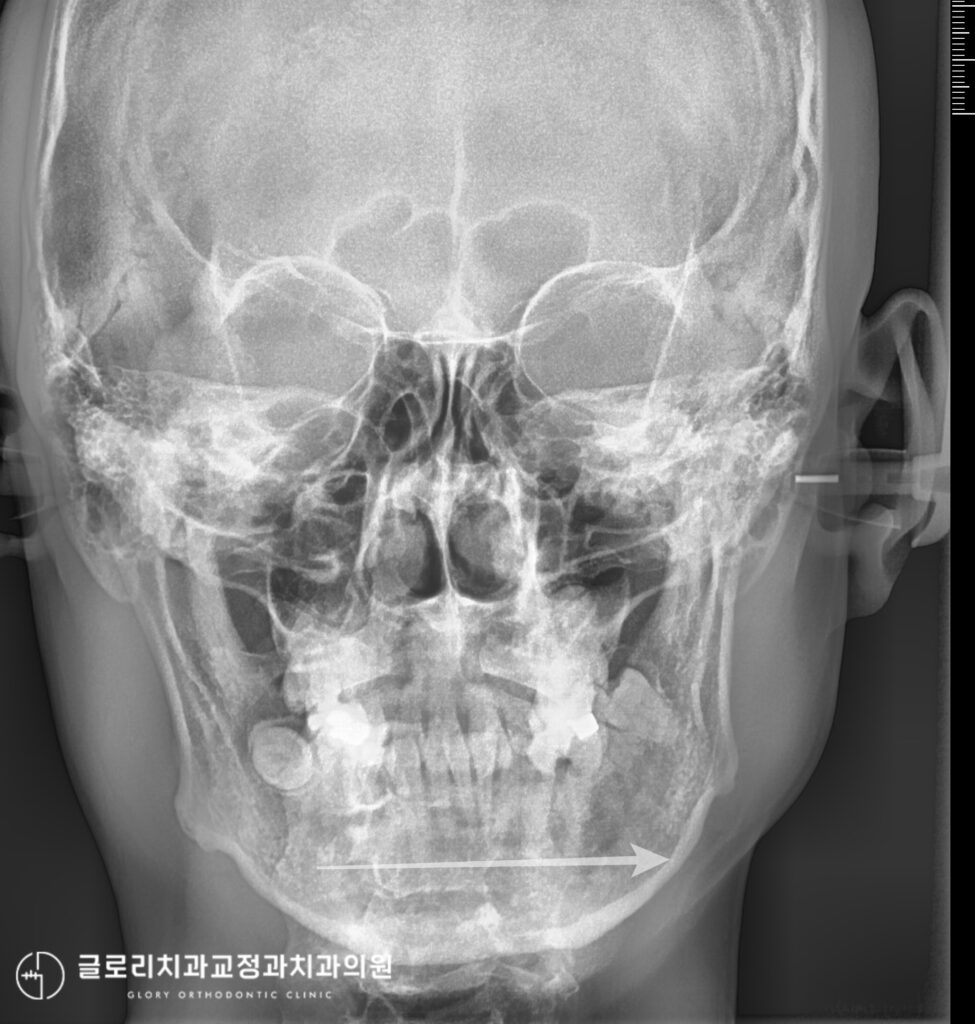 양원역 교정치과 깊게 물리는 과개교합과 심한 총생, 비발치 교정으로 개선할 수 있을까?