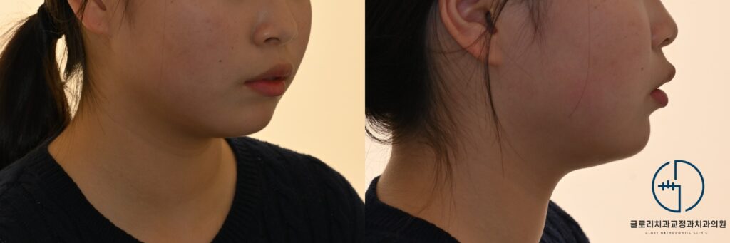 상봉역 치과 돌출된 입이 신경쓰여요: 발치교정으로 2급 부정교합 해결