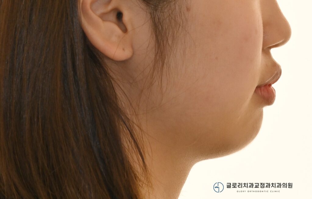 망우역 치과 뻗쳐있는 앞니, 돌출입 개선에 필요한 발치교정에 대해 알아보자.
