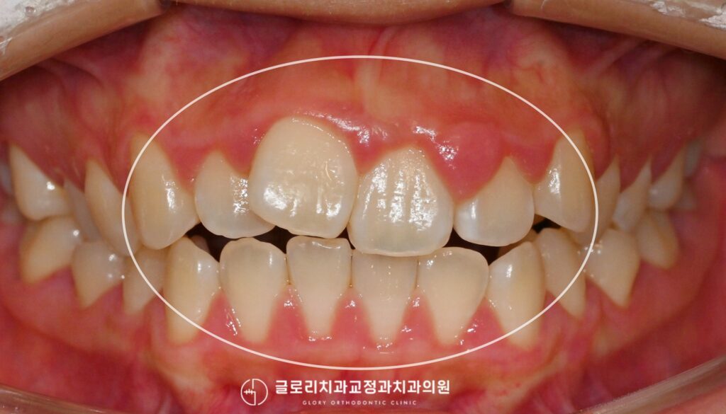 망우동 치과 골격성 2급부정교합: 개방교합 비발치 교정으로도 개선가능할까?