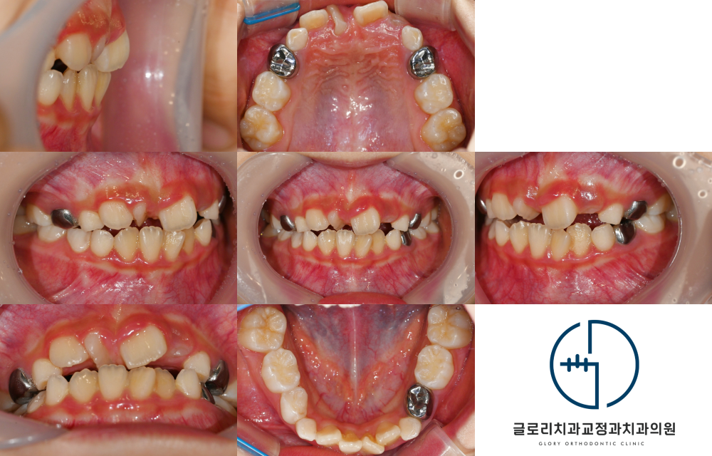 망우동 치과 성장기 소아의 인비절라인을 활용한 교정치료 알아보기