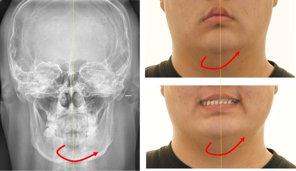 상봉동 치과, 안면부 비대칭을 동반한 반대교합 개선 사례, 상악골확장과 금속 장치 교정