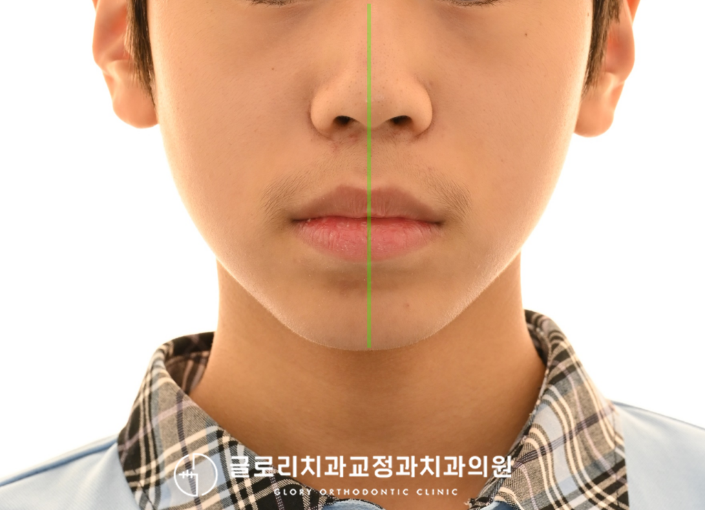 청소년 돌출입 개선을 위한 발치 교정, 과정을 상봉역 치과 에서 알려드립니다.(약 2년)