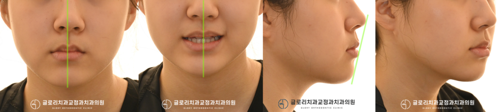 22번 측절치 결손과 반대교합! 교정 과정,+ 목동 치과