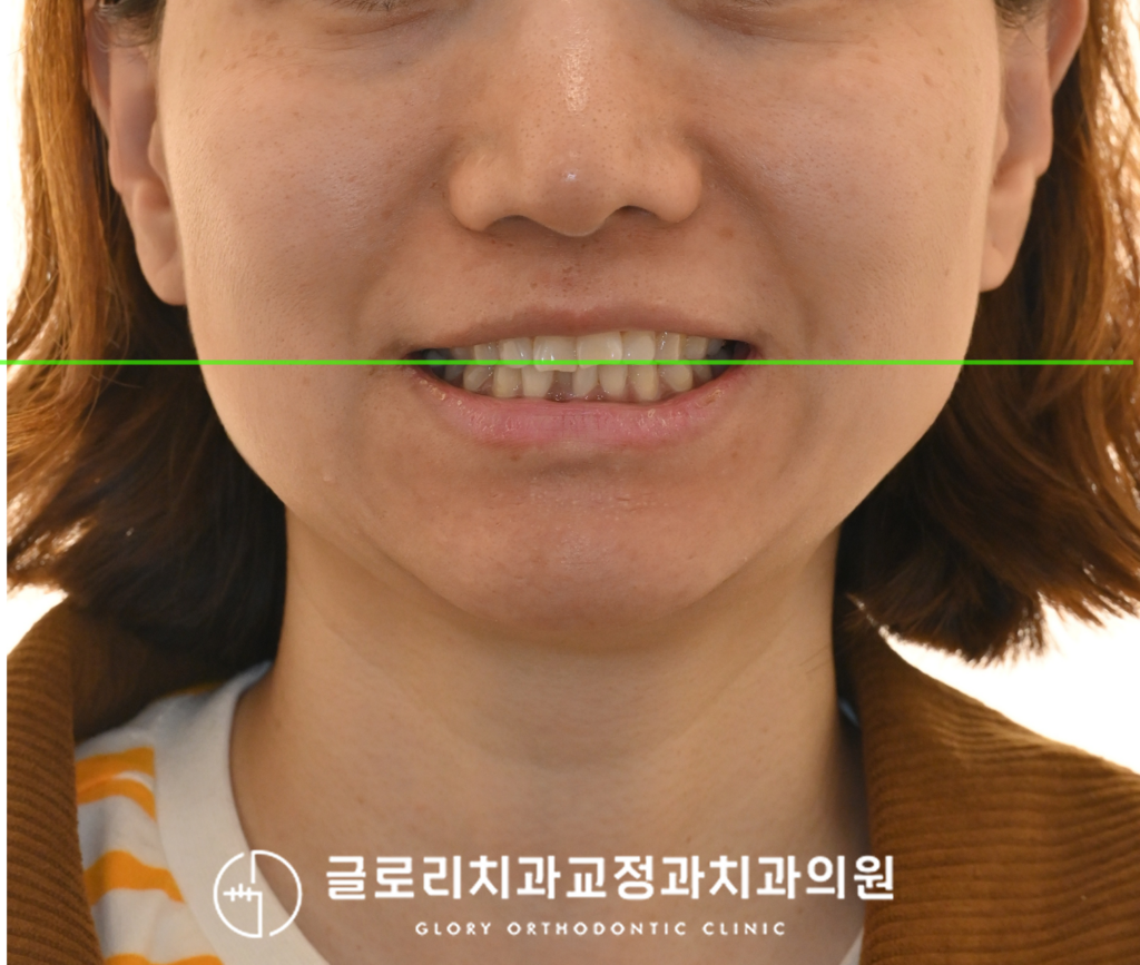 망우동 치과, 앞니 겹침과 정중선 틀어짐, 투명교정으로 개선한 치료 과정