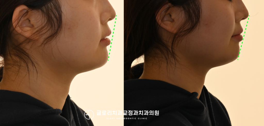 상봉역 치과, 17, 27 선천적 결손 & 하악 제2대구치 직립을 위한 발치 교정 케이스 과정