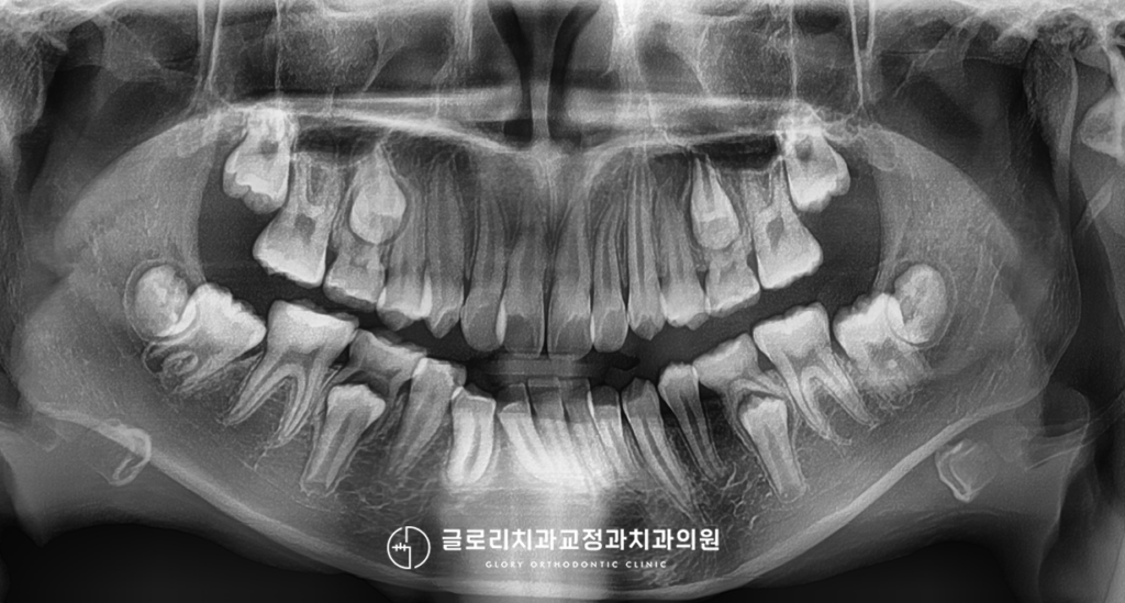 상봉동 치과, 거꾸로 물리는 앞니와 삐뚤빼뚤한 치아, 인비절라인으로 티 안 나고 가지런하게! 약 2년