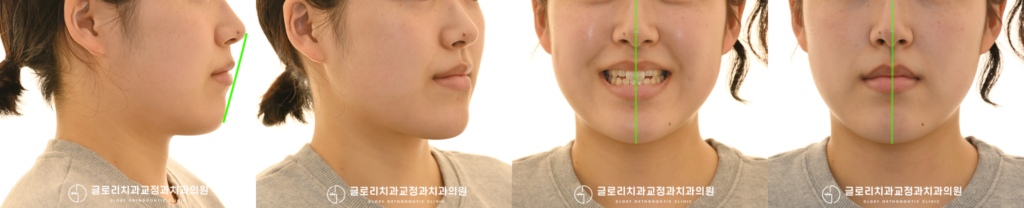 목동치과, 절단교합으로 불편한 식사 정밀한 교합 맞추기 과정 약 2년