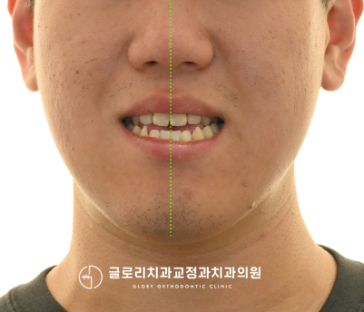 1. 주걱턱으로 스트레스! 비발치 양악수술이 가능할까? 망우동치과