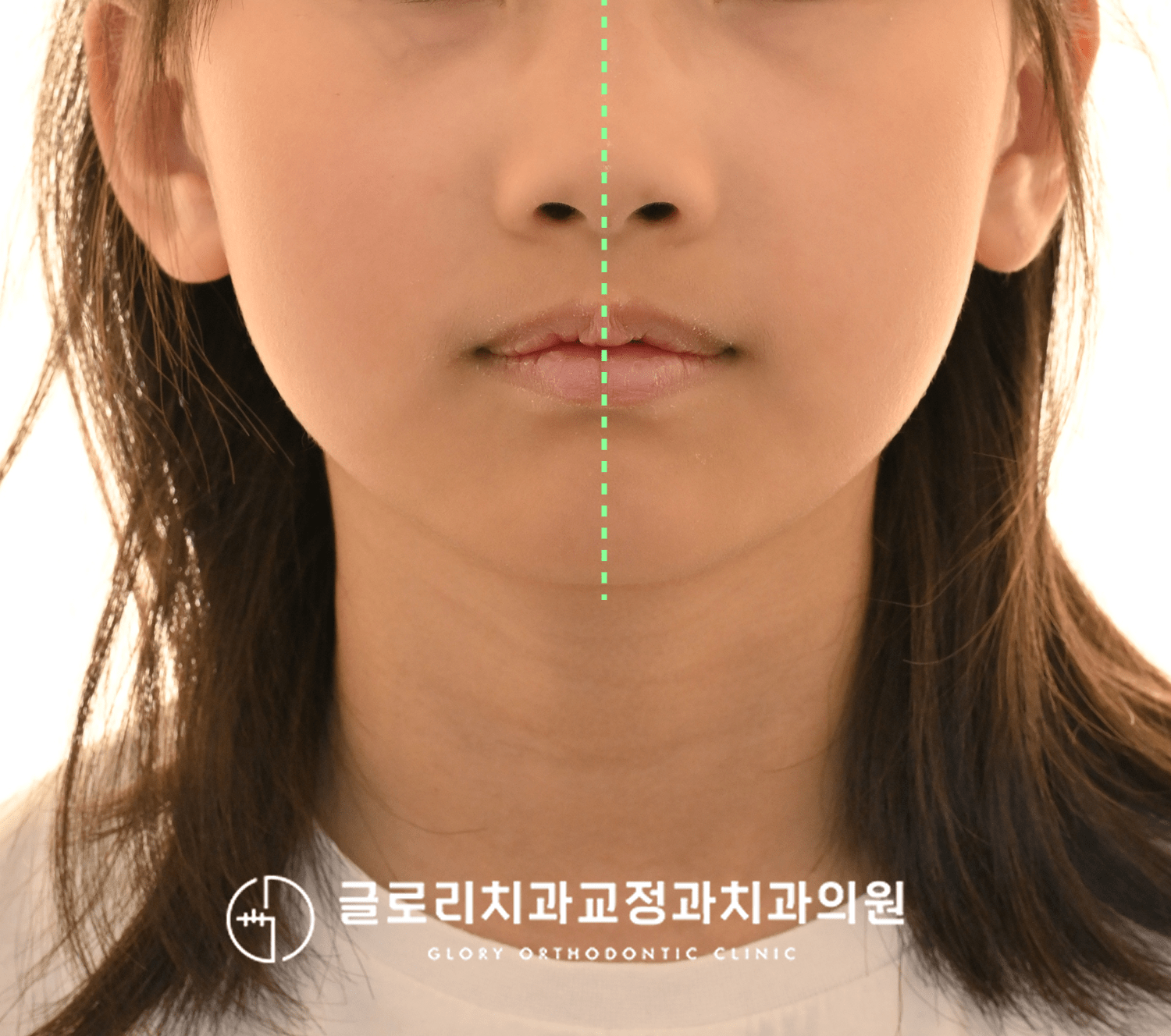2.상봉역치과, 혼합치열기 앞니가 삐뚤빼뚤하다면?(영구치 자리 확보)