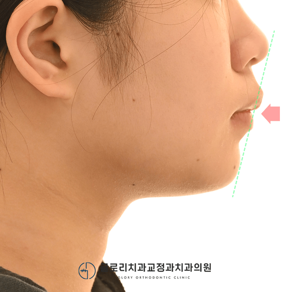 측면 안모 — 입술 돌출 개선 추적