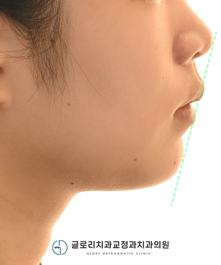 측면 안모 — 개선된 입술 라인