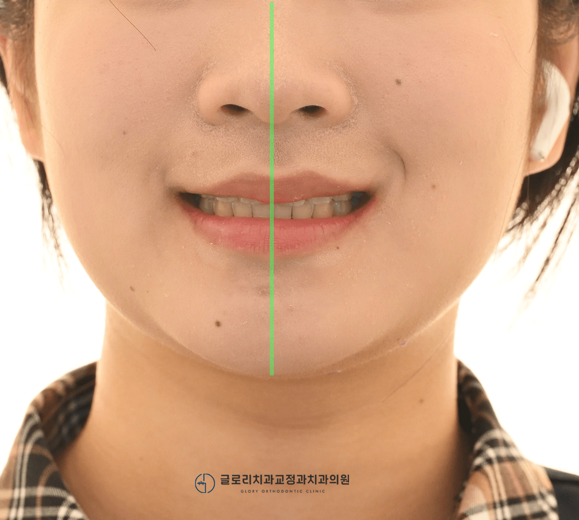 최종 정면 안모 — 대칭성 개선