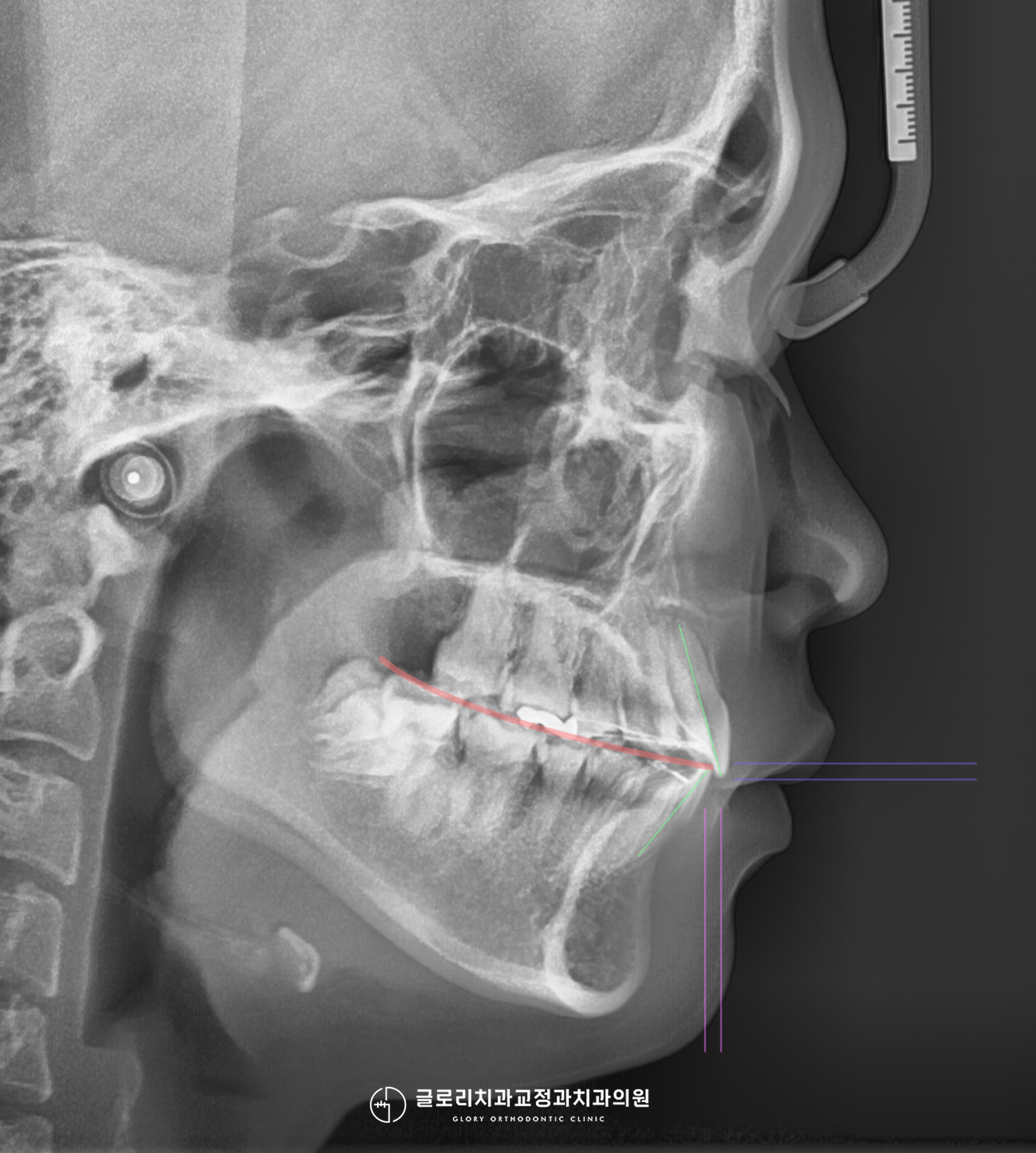 측면 세팔로 — OVERBITE OVERJET 계측