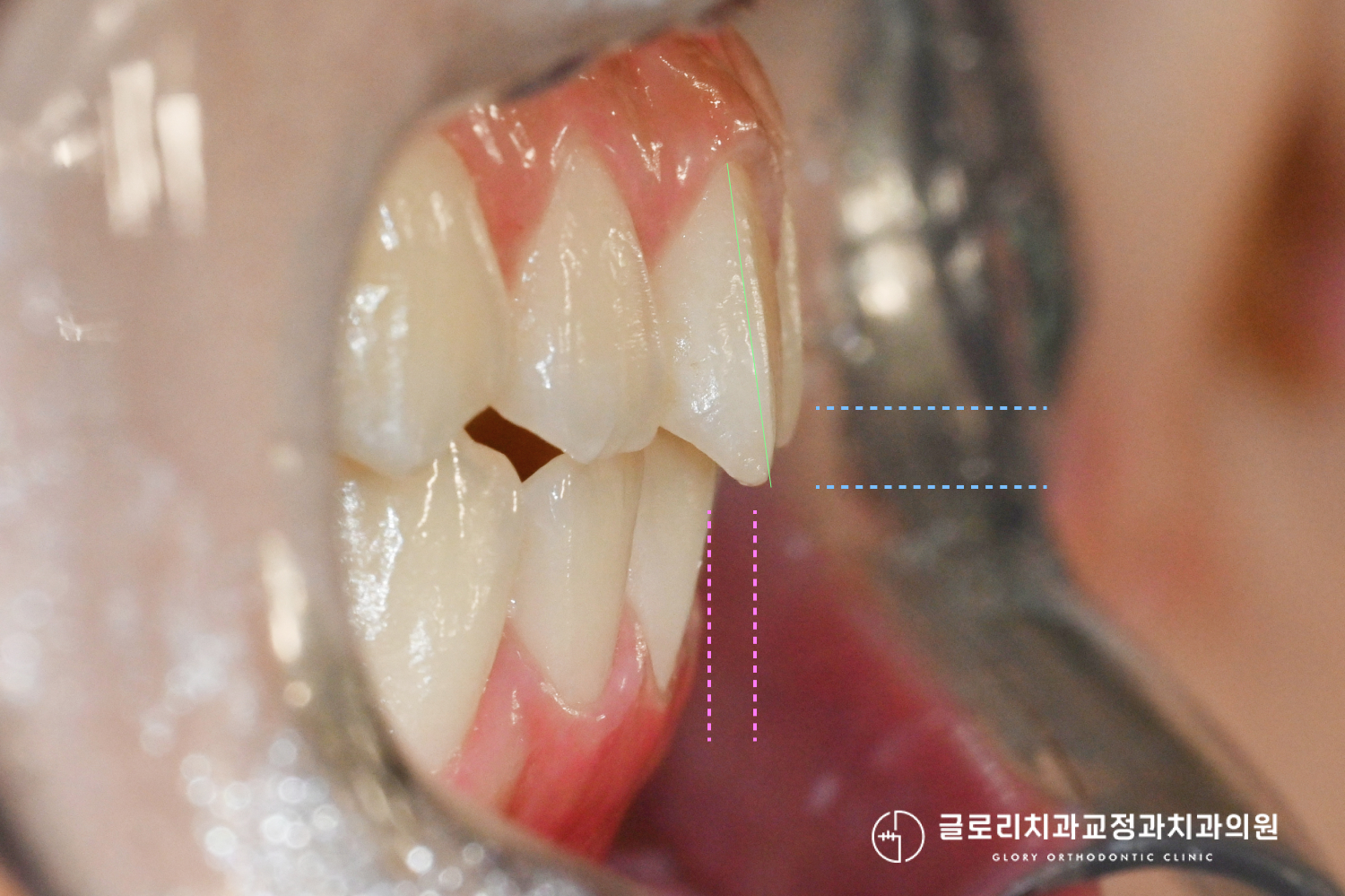 망우역치과 초진 측면 구내사진 — 피개교합 확인