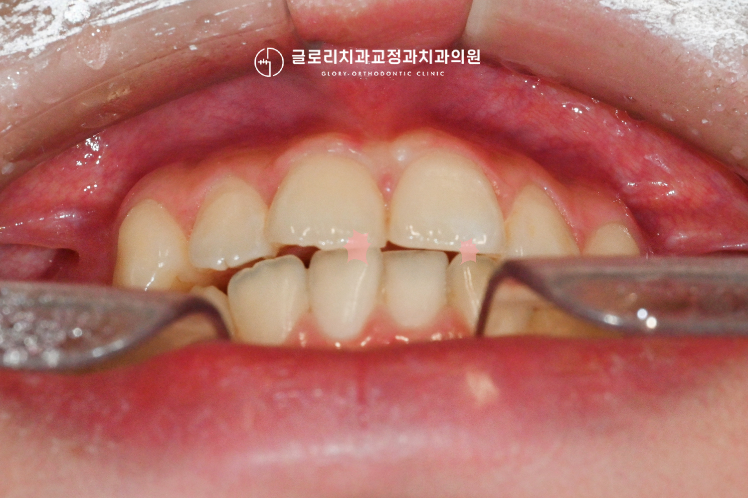 망우역치과 초진 구내사진 — 절단교합 확인