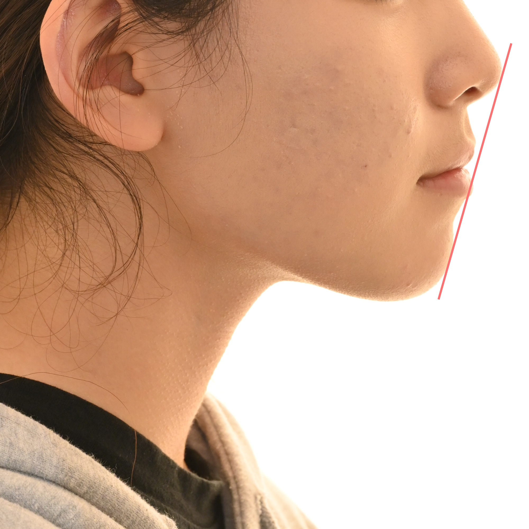 망우역치과 초진 측면 안모 — 입술 돌출도 평가