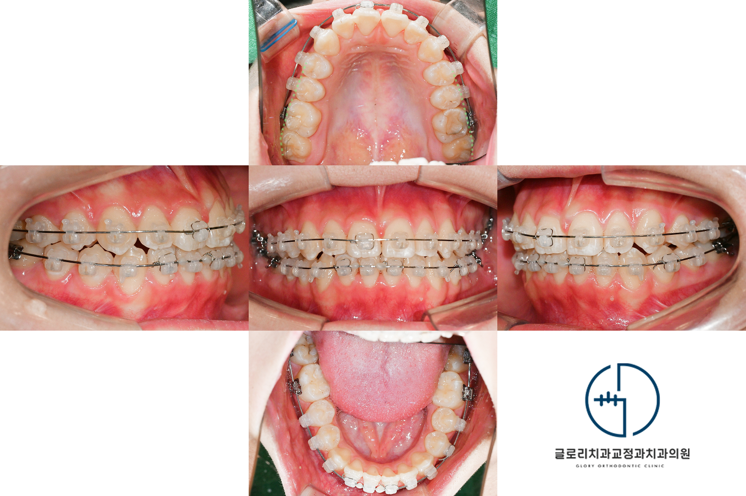 망우역치과 교정 경과 구내사진 2026년 1월 — 배열 진행