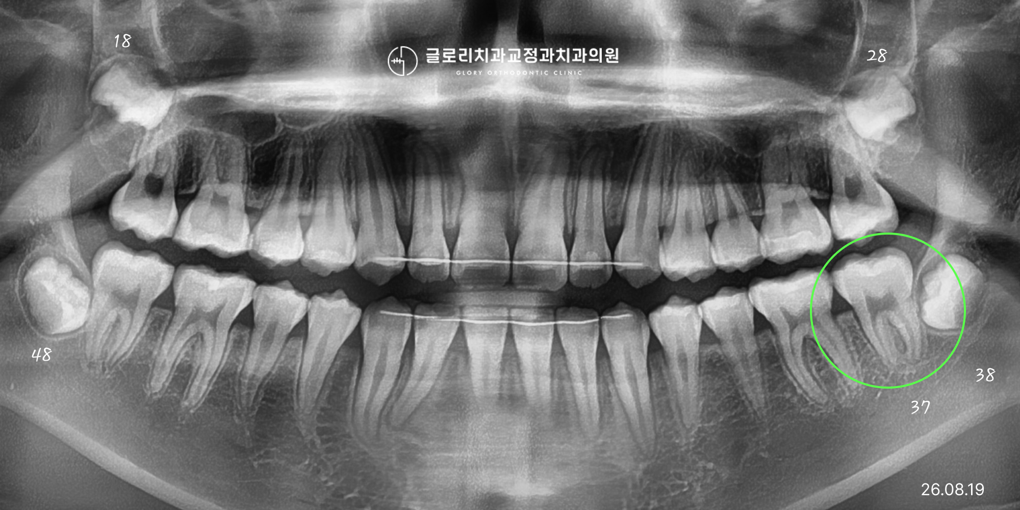 망우역치과 최근 경과 파노라마 — 37번 치아 직립 진행
