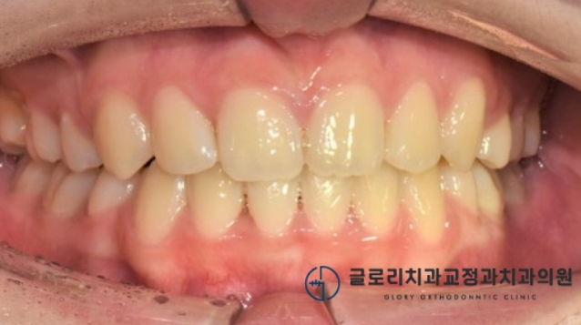 치료 후