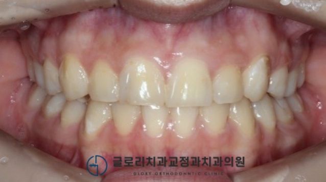 치료 후